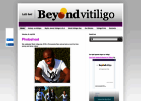 beyondvitiligosa.blogspot.com