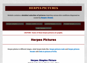 herpes-coldsores-treatment-pictures.com